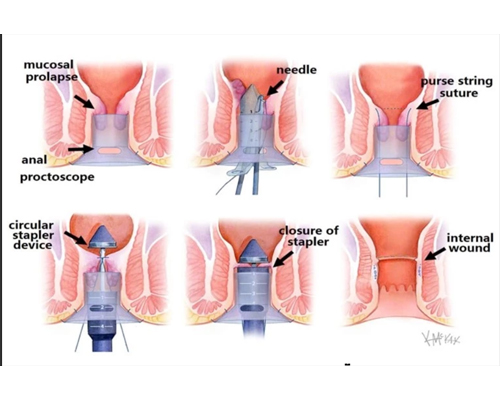Constipation Treatment Mumbai