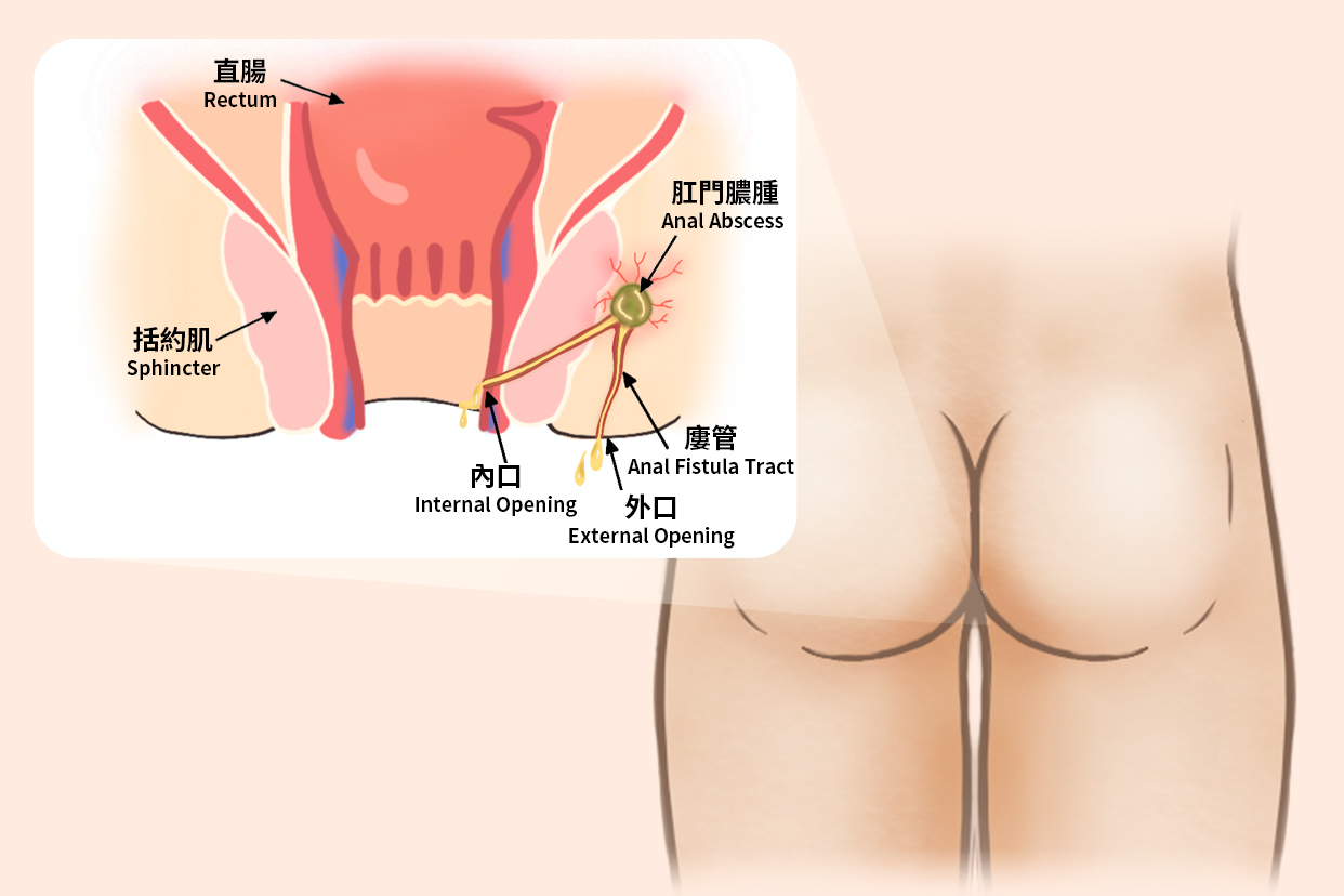 Fistula Treatment Mumbai