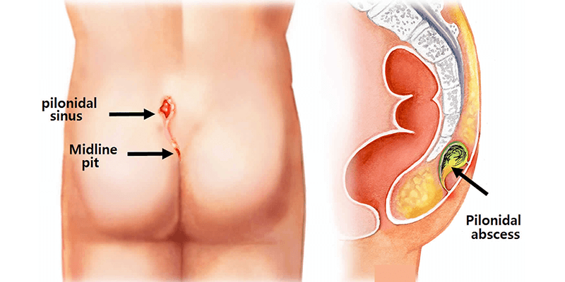 Pilonidal Sinus Treatment Mumbai