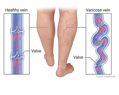 Varicose Veins Treatment Mumbai